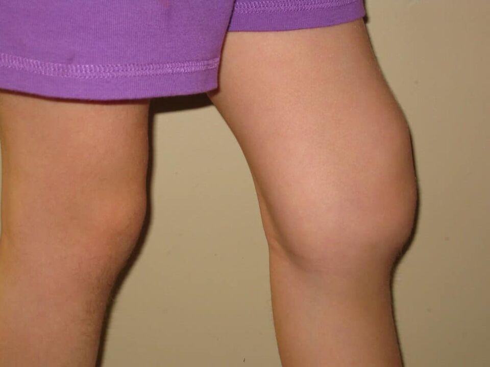 Patologie kolena s pokročilou artrózou