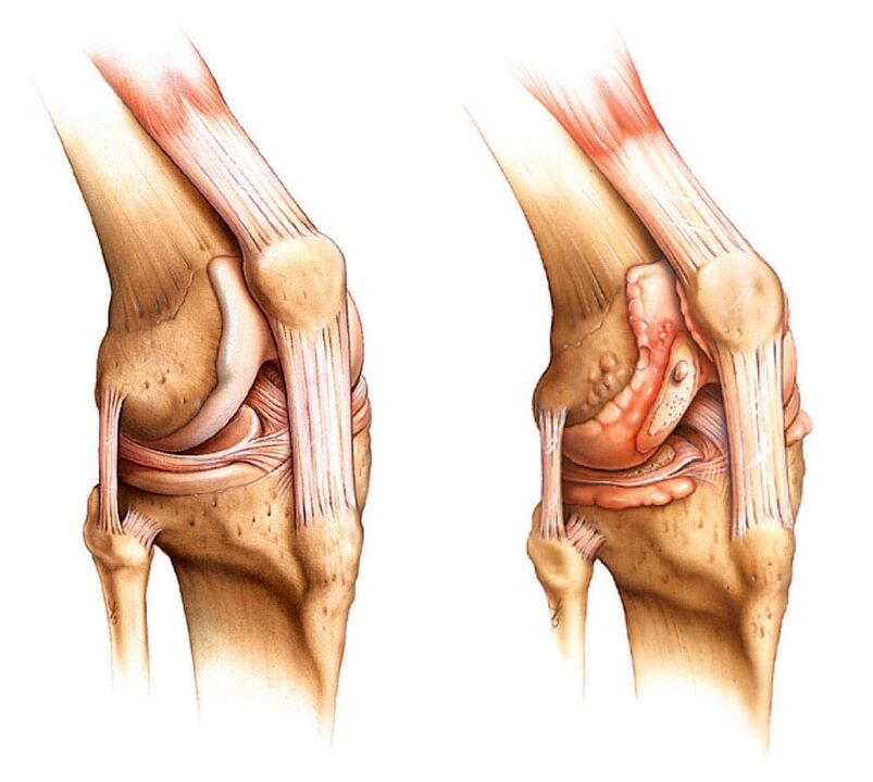 Zdravý kloub (vlevo) a artritický kloub (vpravo)