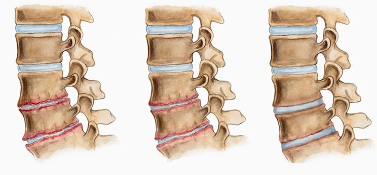 Deformace meziobratlových plotének při osteochondróze může způsobit bolesti zad
