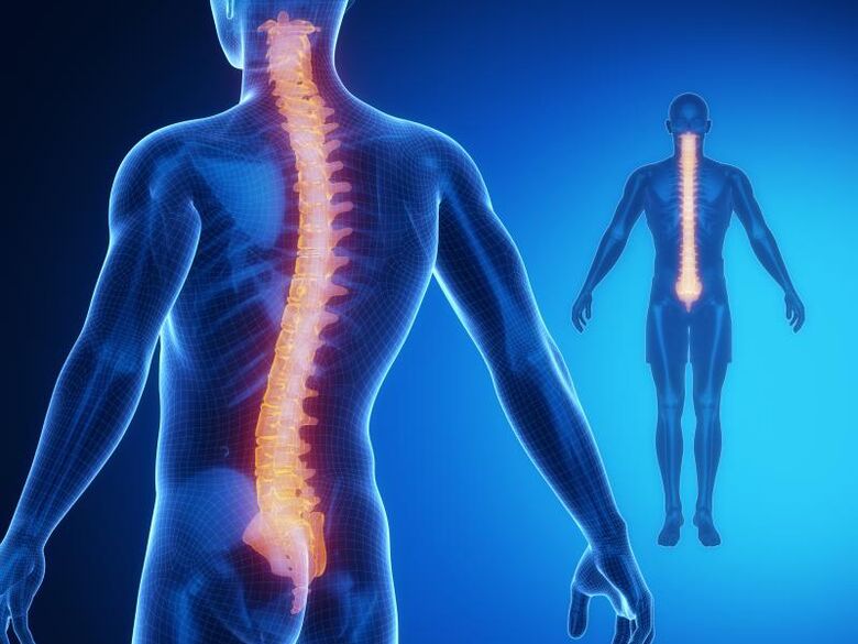 Osteochondróza páteře, vyžadující komplexní léčbu