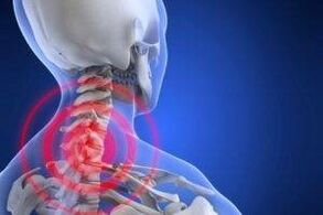 bolest na krku s osteochondrózou