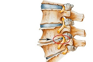 sevřený disk páteře jako příčina cervikální osteochondrózy