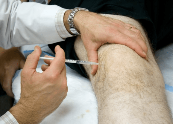 Intra -artikulární podávání analgetik při těžké bolesti